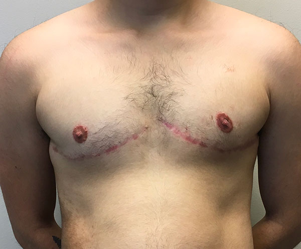 Female To Male Top Surgery 73