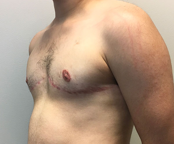 Female To Male Top Surgery 03