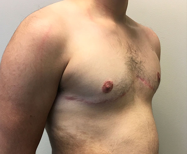 Female To Male Top Surgery 05