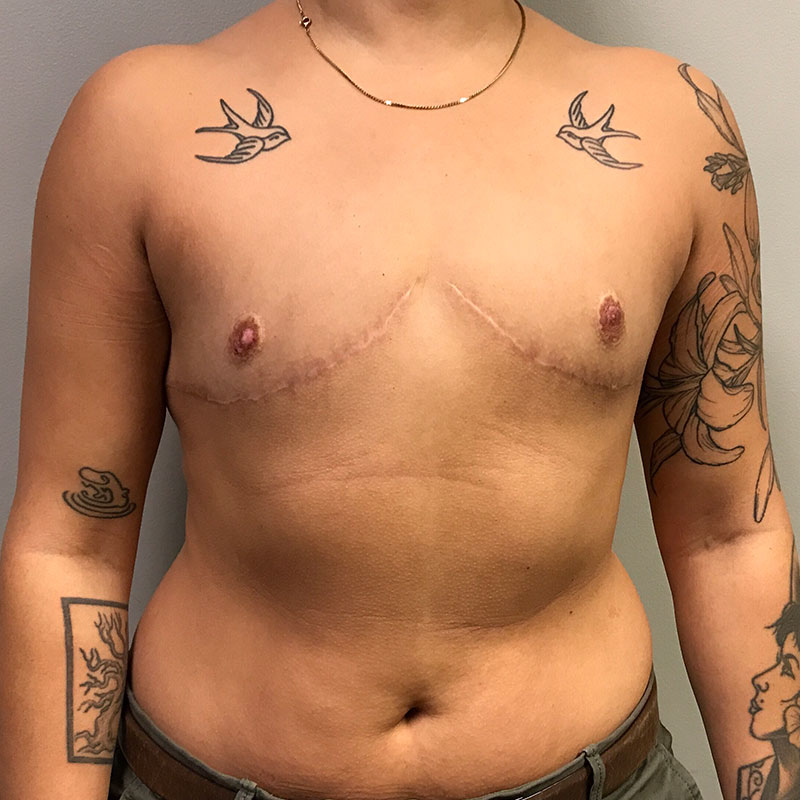 Female To Male Top Surgery 74