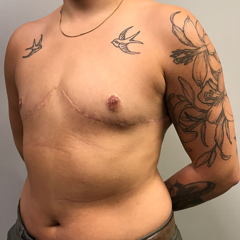 Female To Male Top Surgery 03