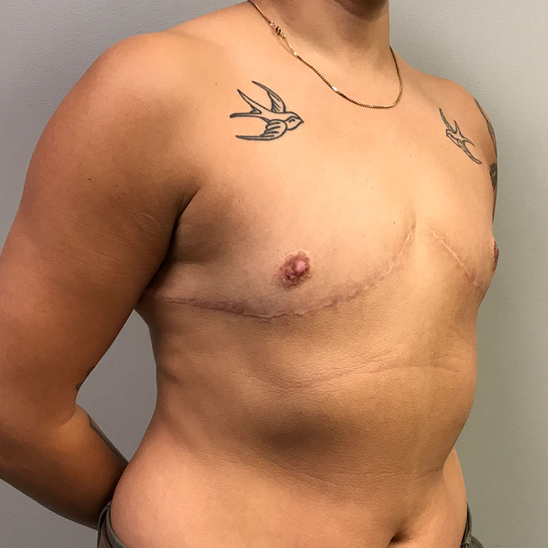 Female To Male Top Surgery 05