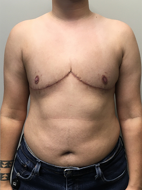 Female To Male Top Surgery 75