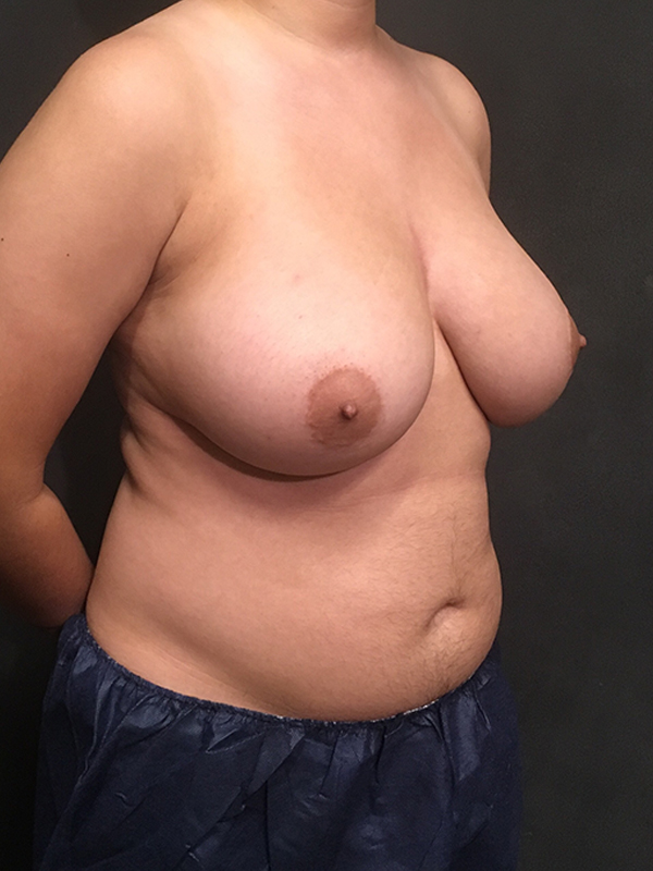 Female To Male Top Surgery 05