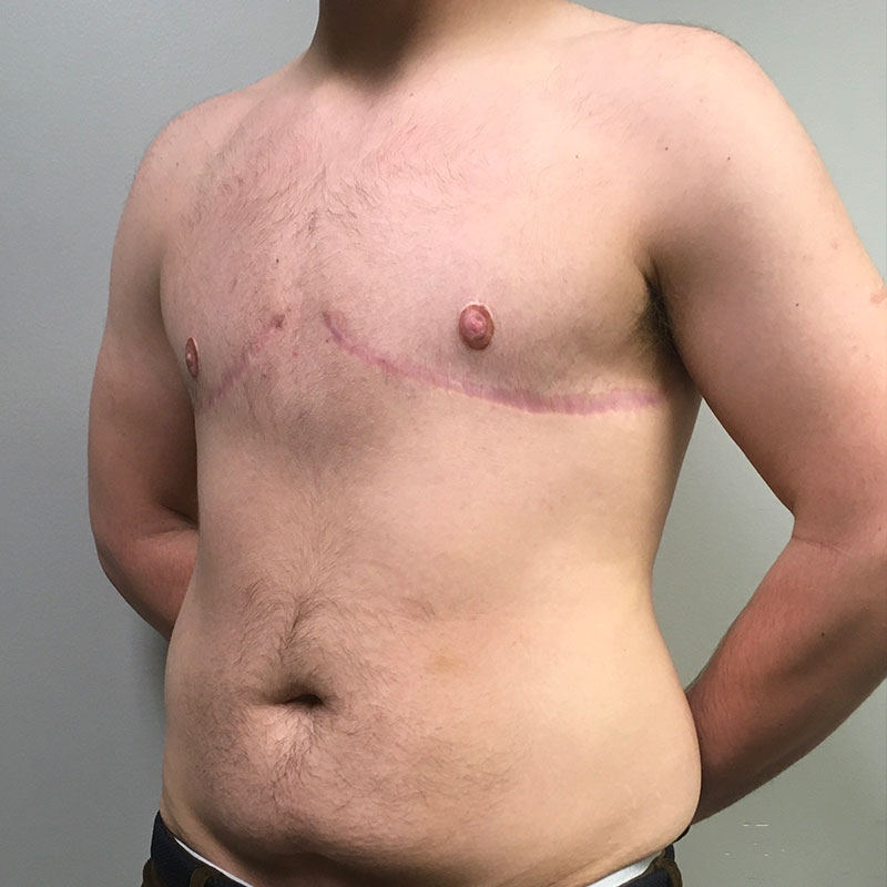 Female To Male Top Surgery 03