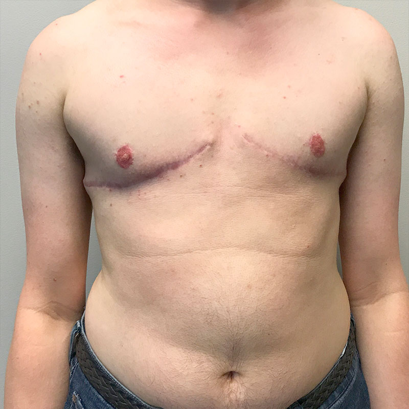 Female To Male Top Surgery 77