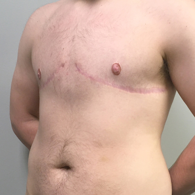 Female To Male Top Surgery 03