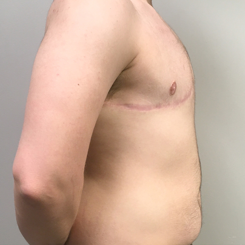 Female To Male Top Surgery 05