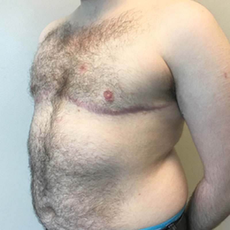 Female To Male Top Surgery 03