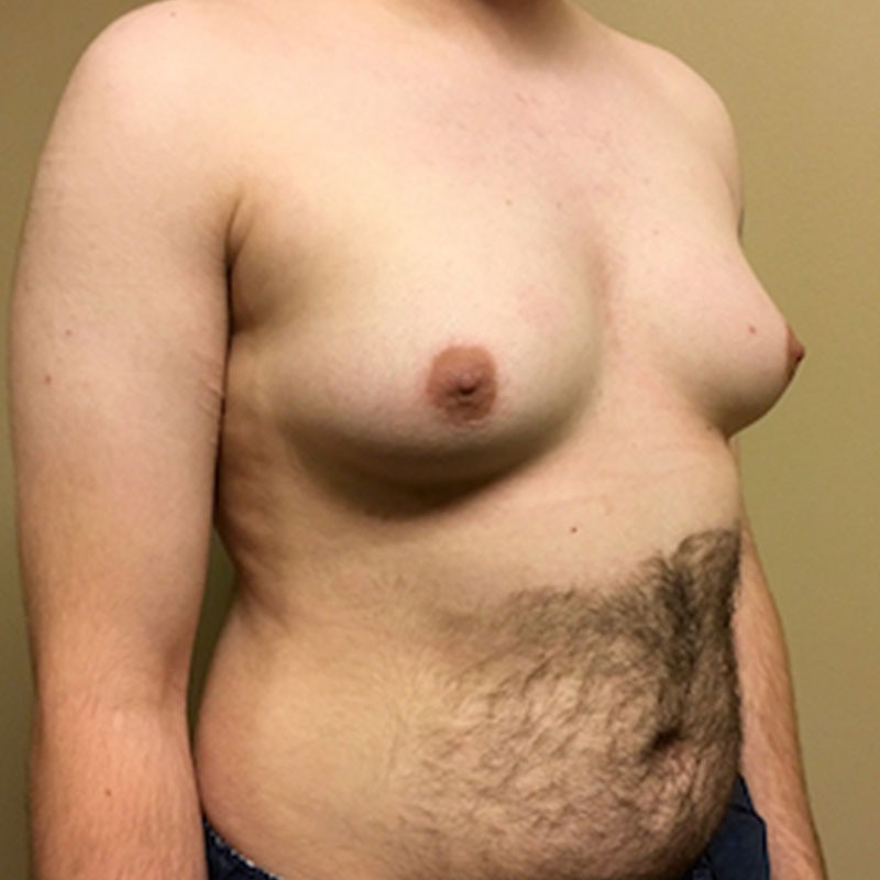 Female To Male Top Surgery 05
