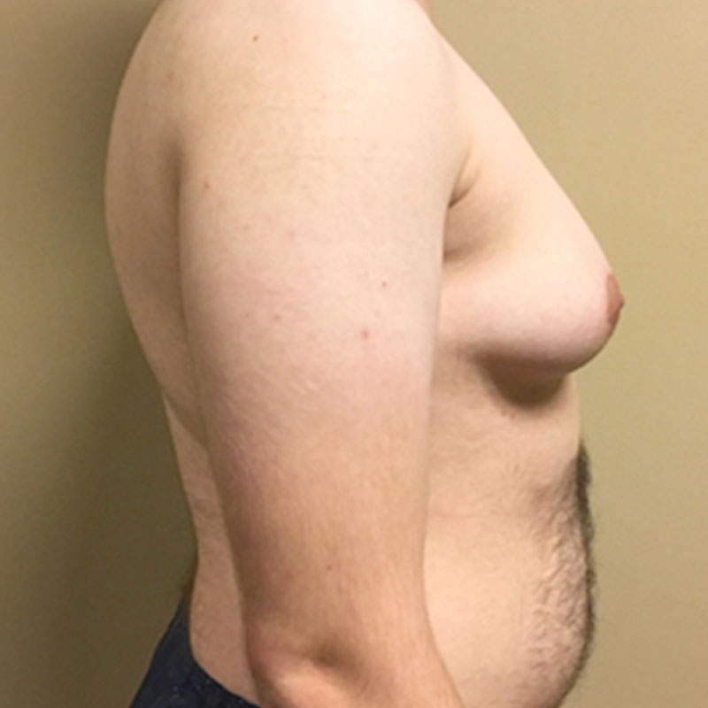 Female To Male Top Surgery 07