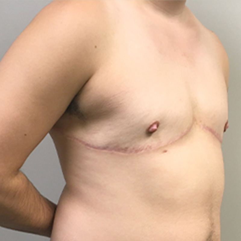 Female To Male Top Surgery 03