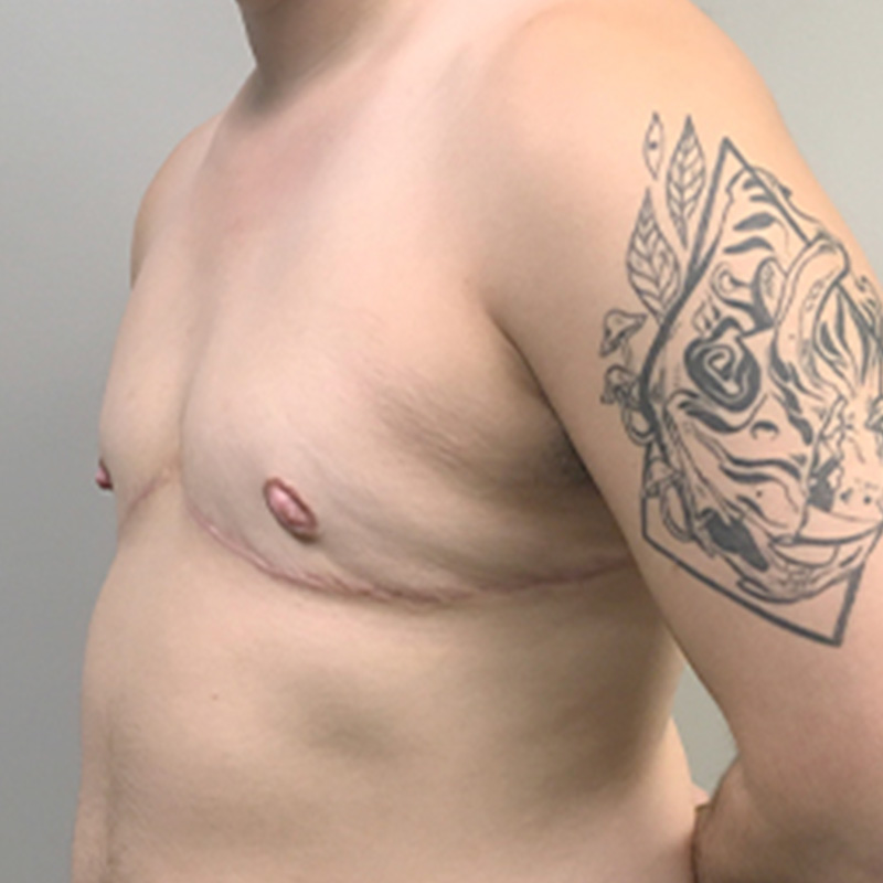 Female To Male Top Surgery 07