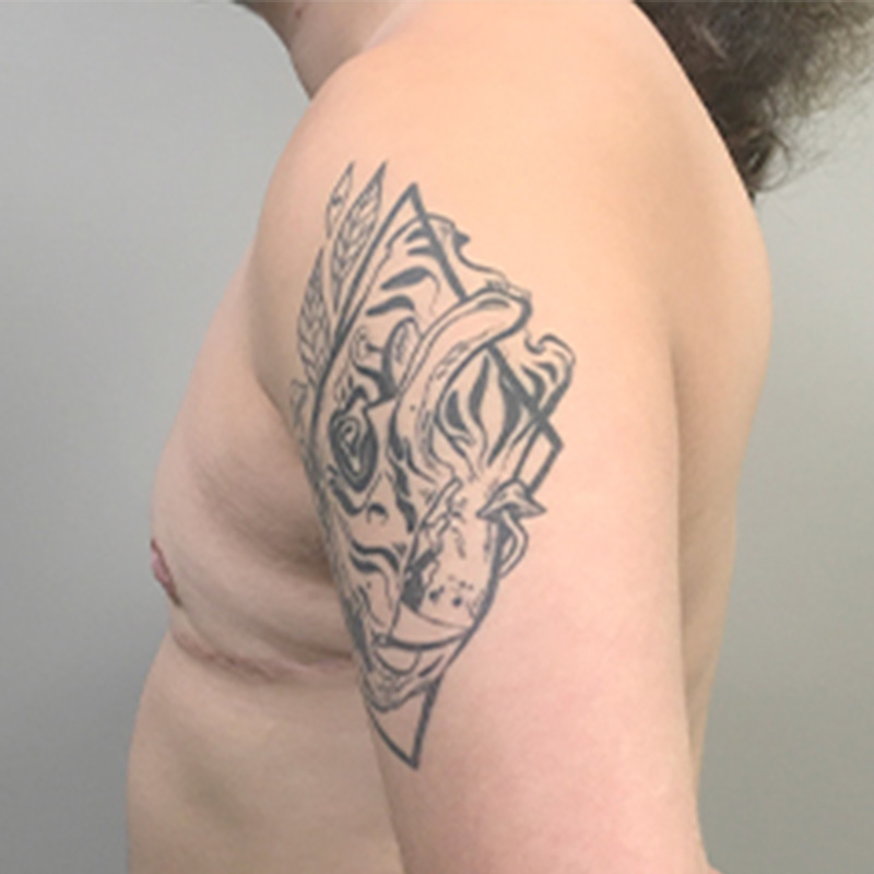 Female To Male Top Surgery 09