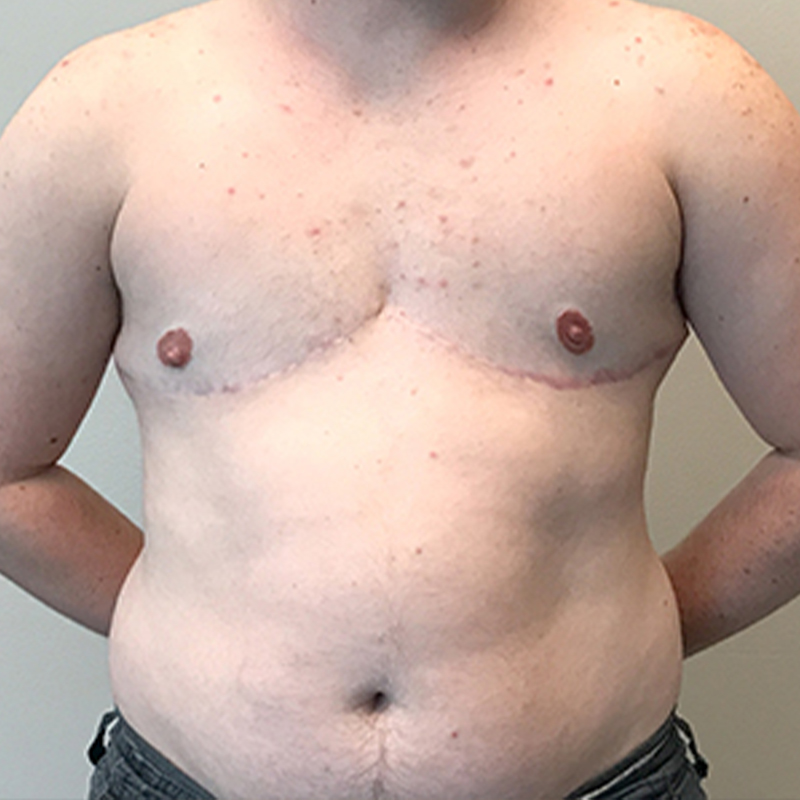 Female To Male Top Surgery 81