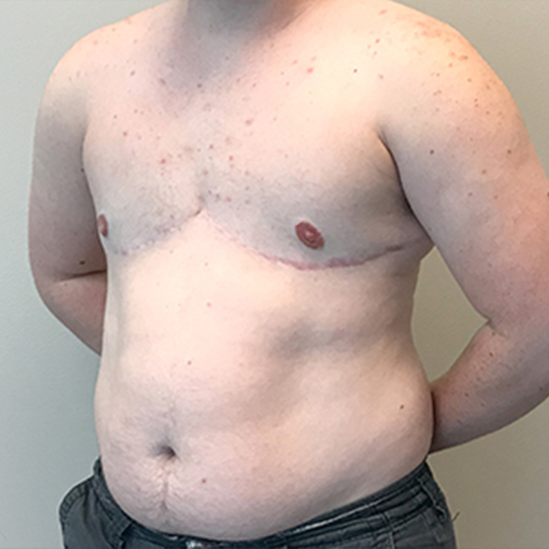 Female To Male Top Surgery 03