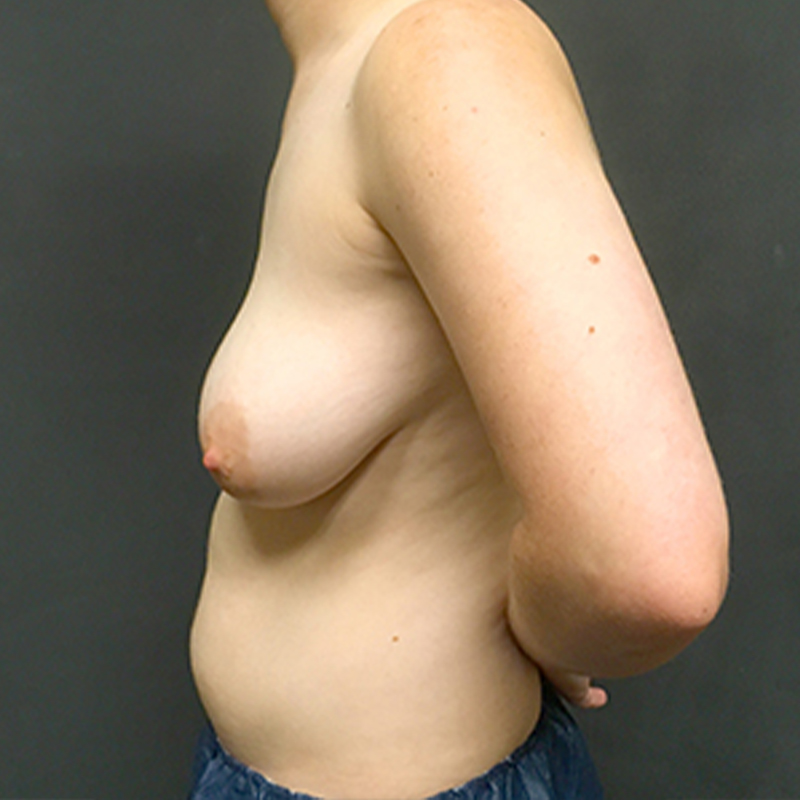 Female To Male Top Surgery 05