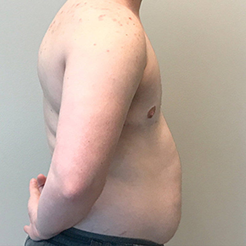 Female To Male Top Surgery 09