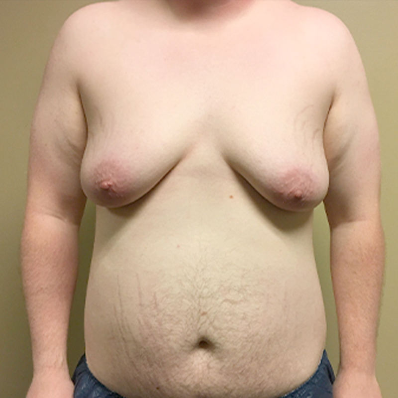 Female To Male Top Surgery 01