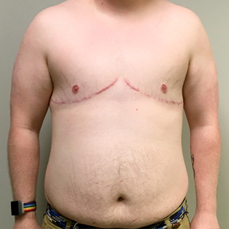 Female To Male Top Surgery 82