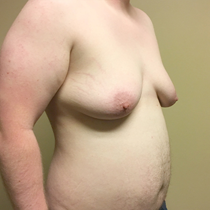 Female To Male Top Surgery 03