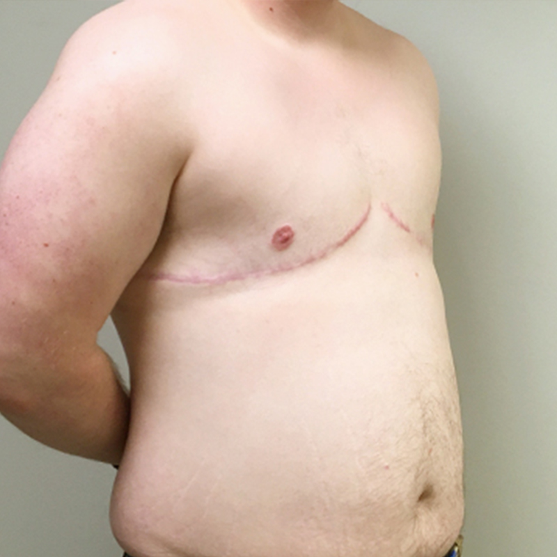 Female To Male Top Surgery 03