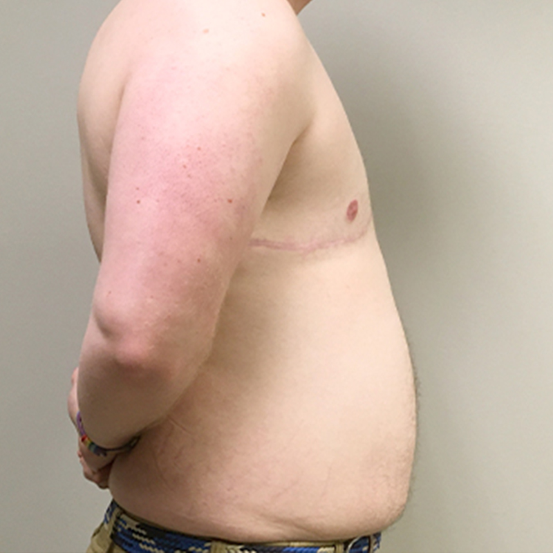 Female To Male Top Surgery 05