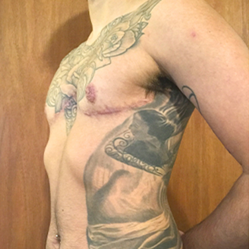 Female To Male Top Surgery 03