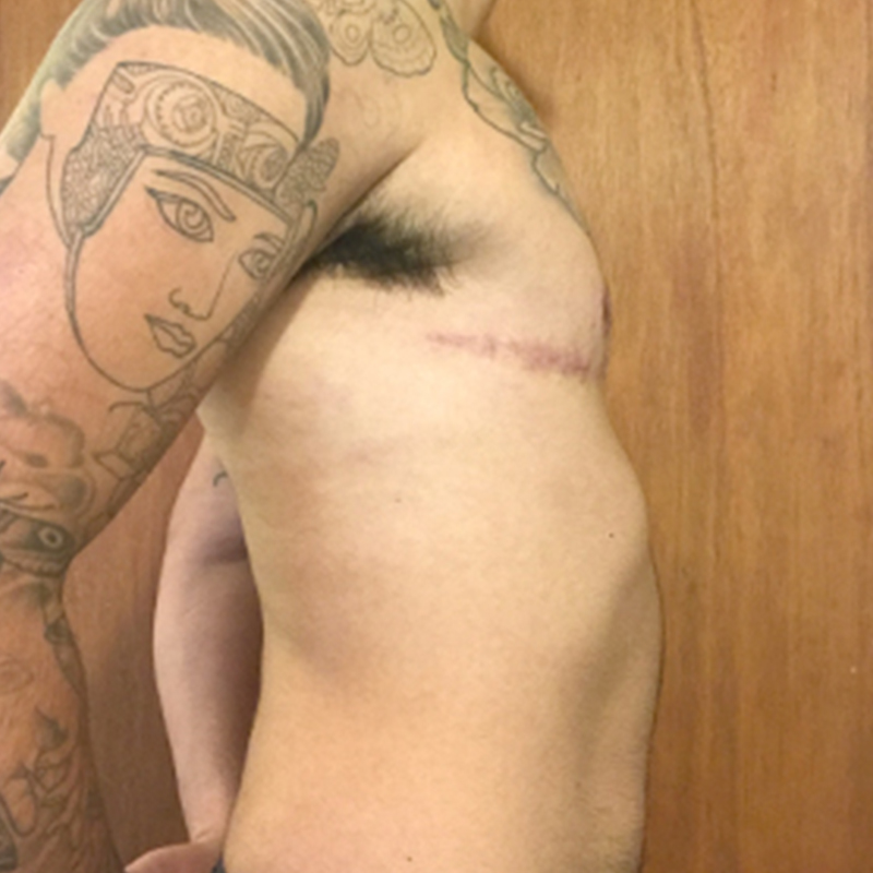 Female To Male Top Surgery 09