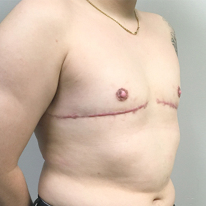 Female To Male Top Surgery 03