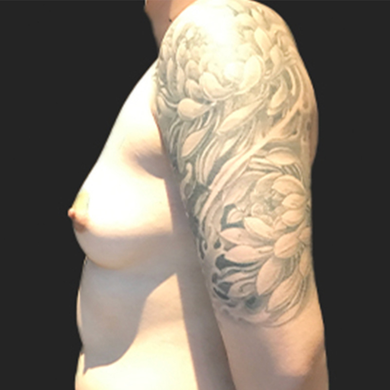 Female To Male Top Surgery 09