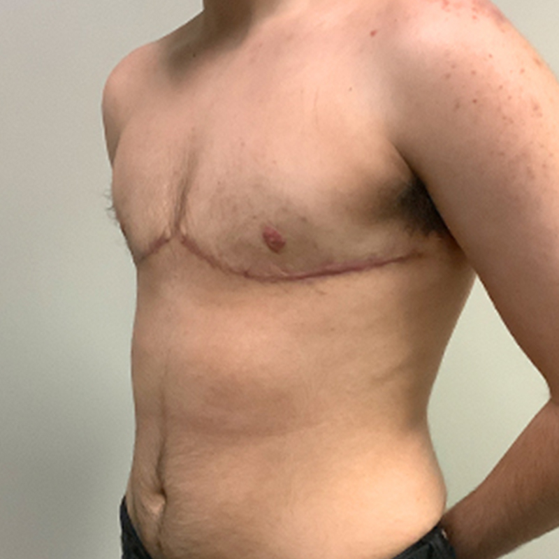 Female To Male Top Surgery 03