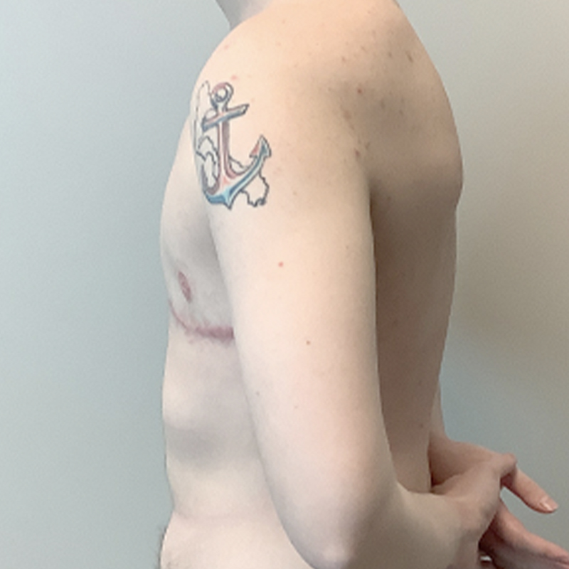 Female To Male Top Surgery 05