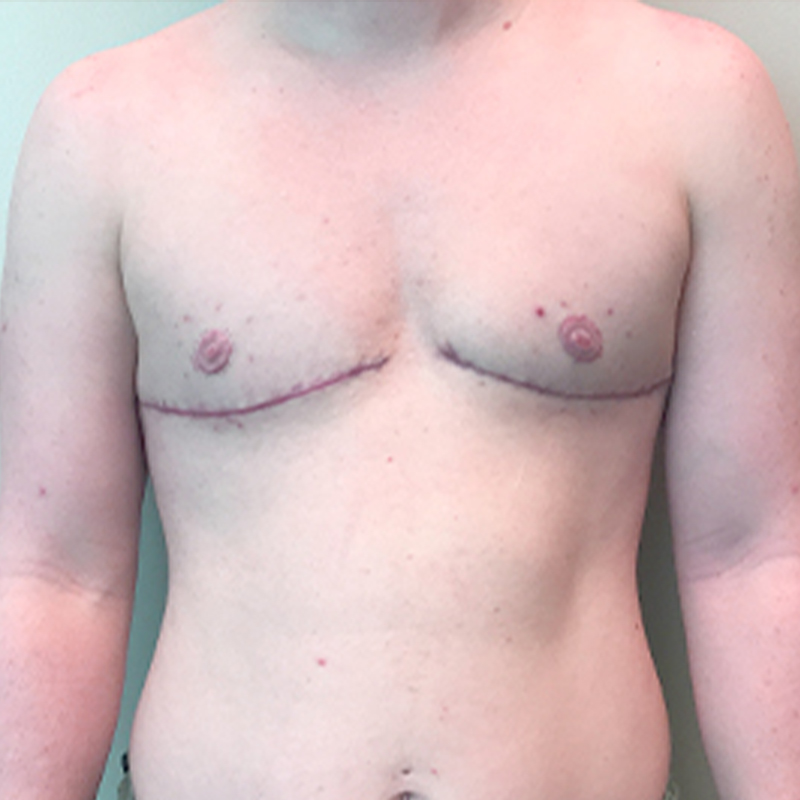 Female To Male Top Surgery 88