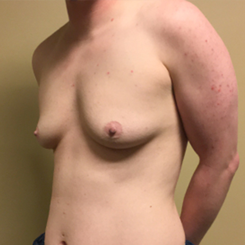 Female To Male Top Surgery 03