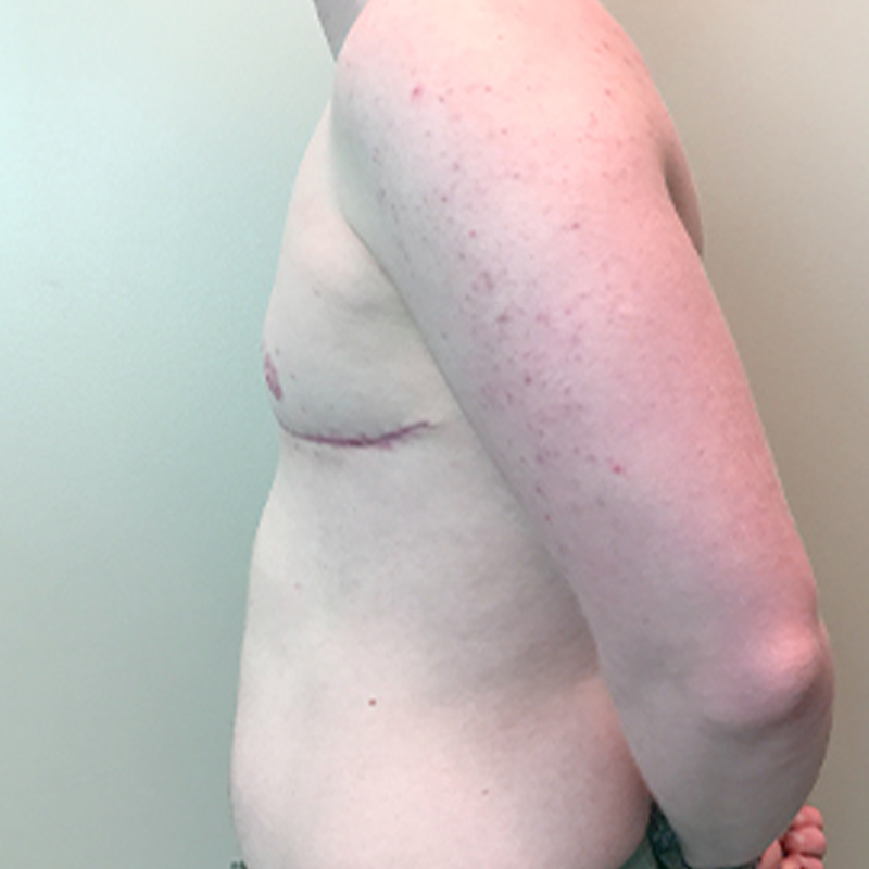 Female To Male Top Surgery 05