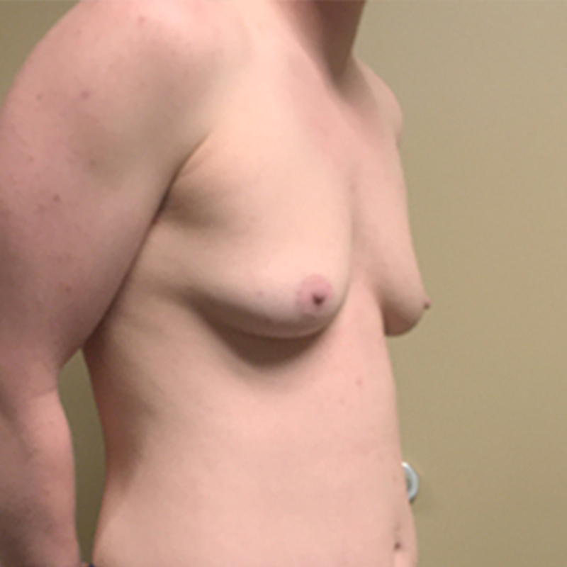 Female To Male Top Surgery 07