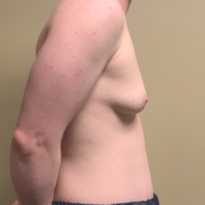 Female To Male Top Surgery 09