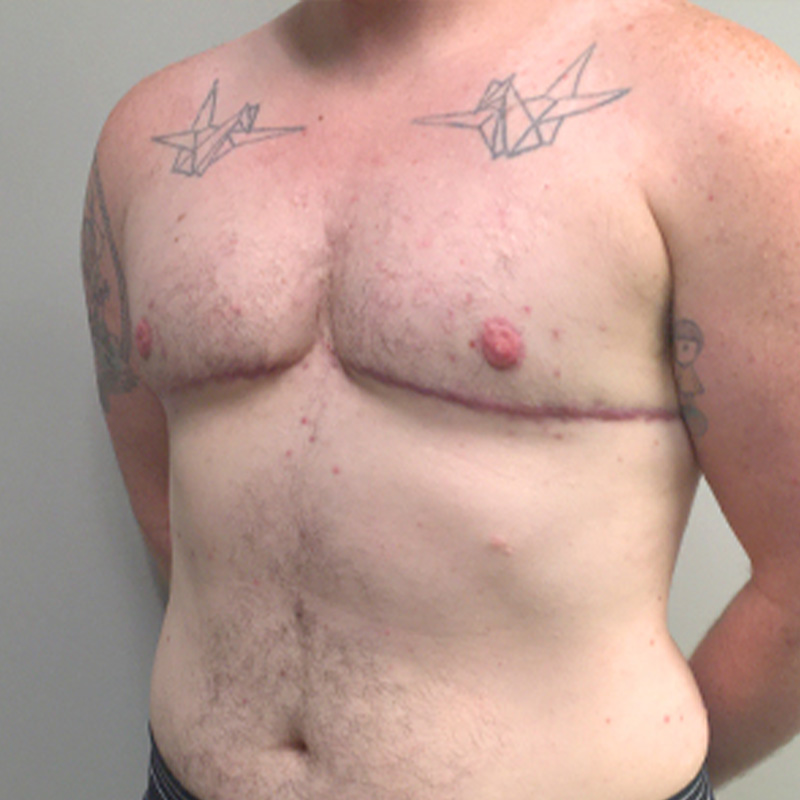 Female To Male Top Surgery 03