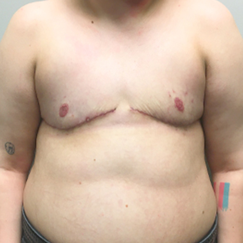 Female To Male Top Surgery 90