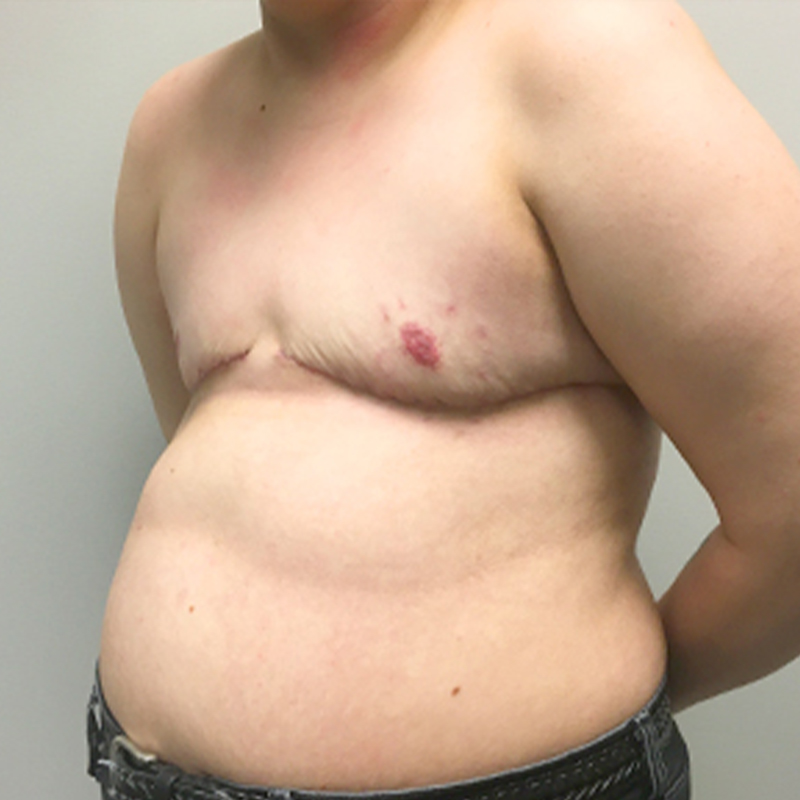 Female To Male Top Surgery 03