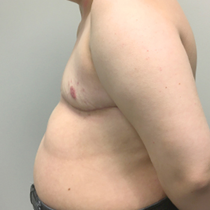 Female To Male Top Surgery 05