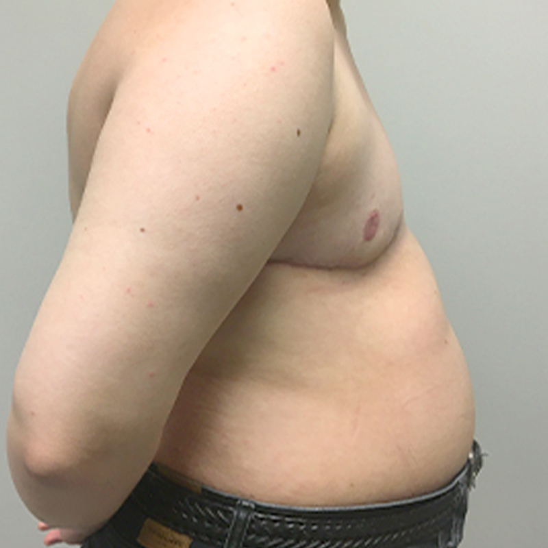 Female To Male Top Surgery 09