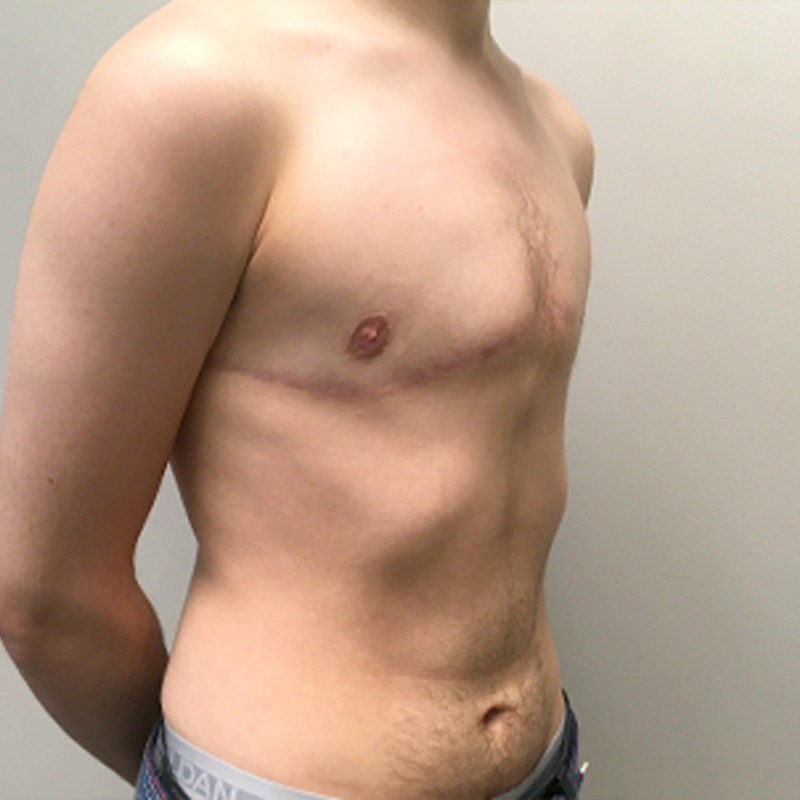 Female To Male Top Surgery 07