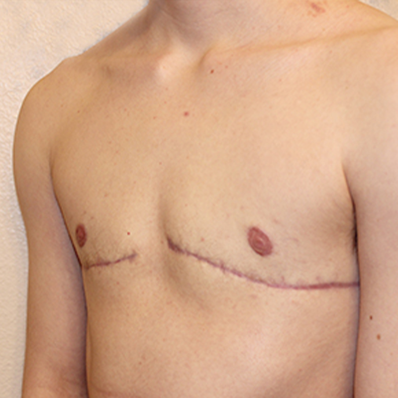 Female To Male Top Surgery 03