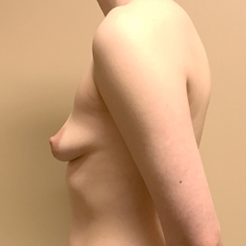 Female To Male Top Surgery 05