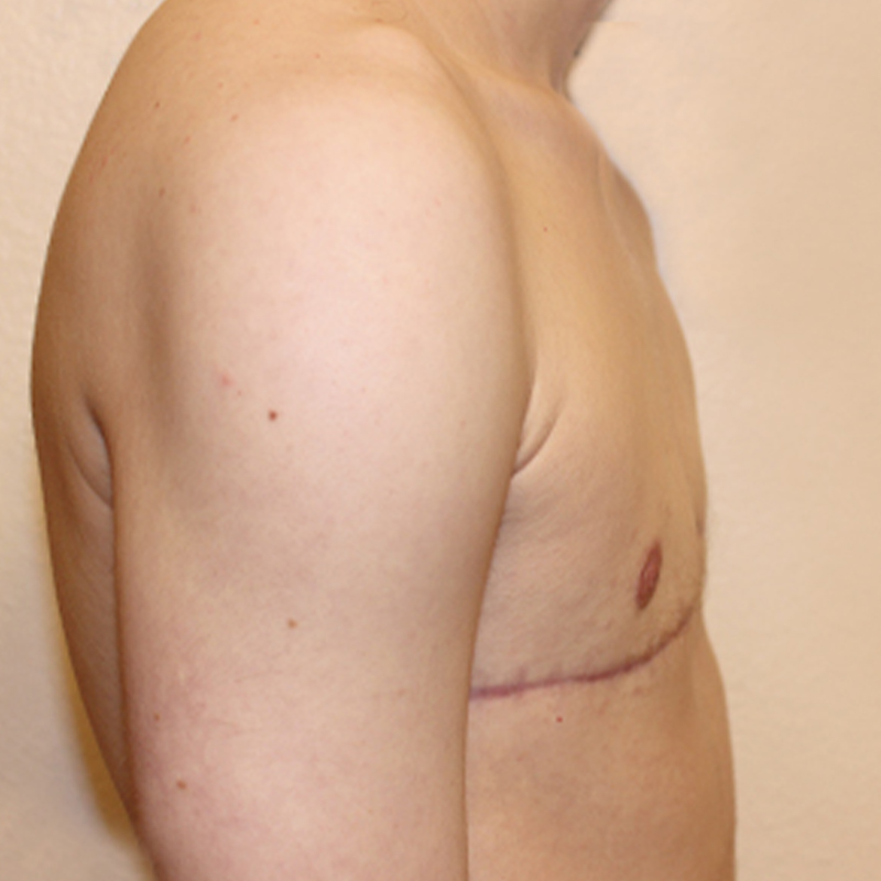 Female To Male Top Surgery 09