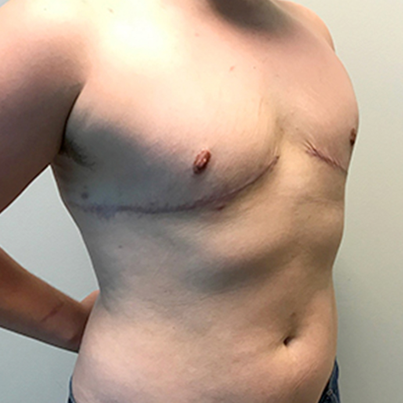 Female To Male Top Surgery 07