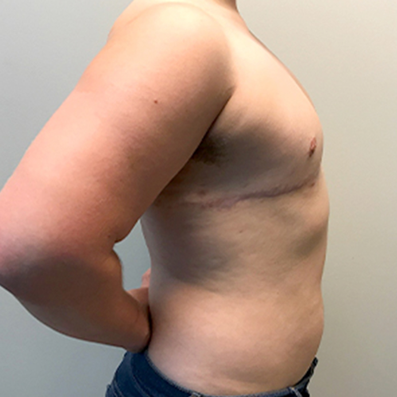 Female To Male Top Surgery 09