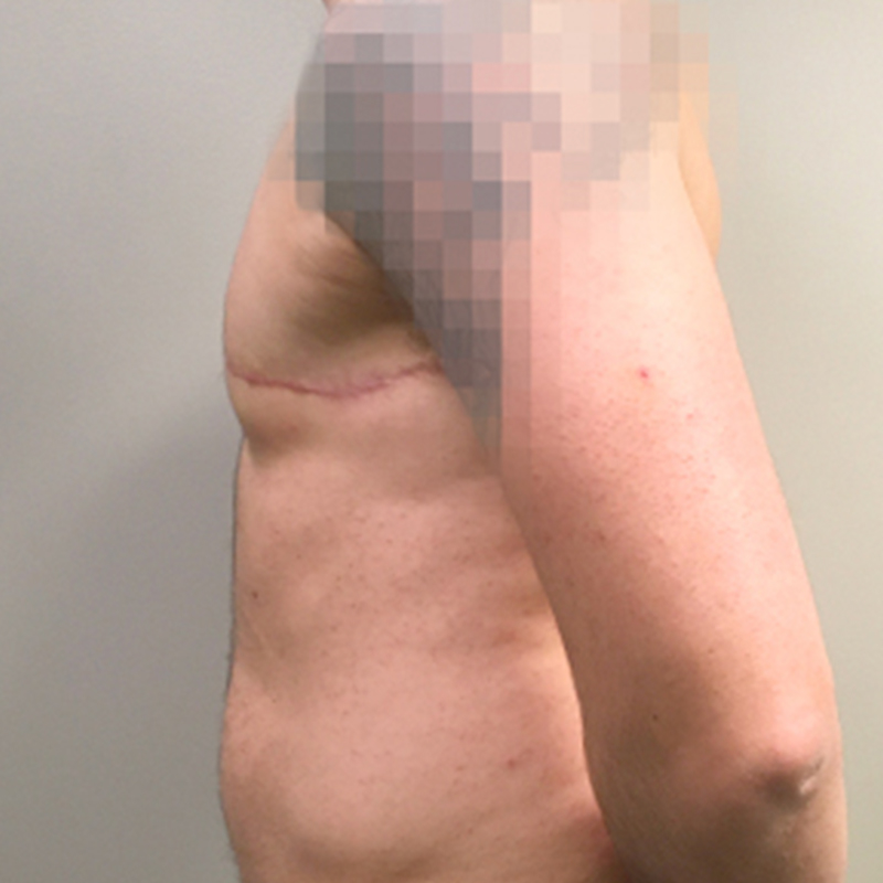 Female To Male Top Surgery 05